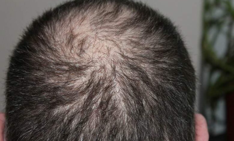 Haarausfall – Ist noch etwas zu retten? 1
