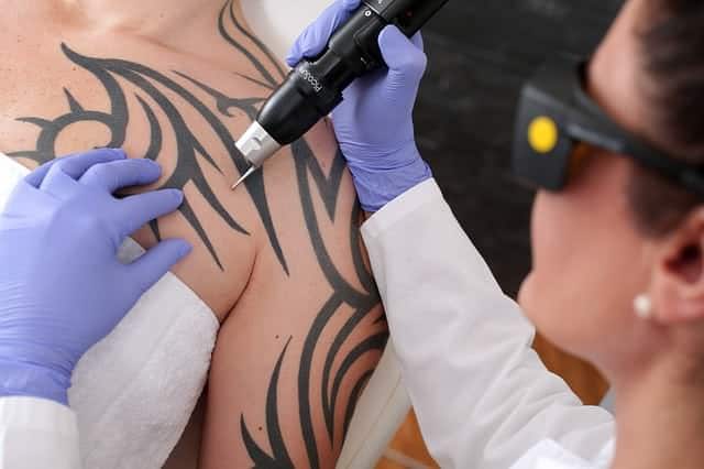 Laserbehandlung - was ist das eigentlich? 1