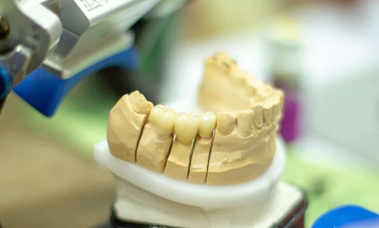 Zahnersatz: Zahnkronen, Brücken und Implantate 1