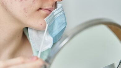 Periorale Dermatitis durch Maskenpflicht 1