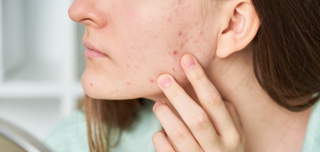 Periorale Dermatitis durch Maskenpflicht 2 Periorale Dermatitis